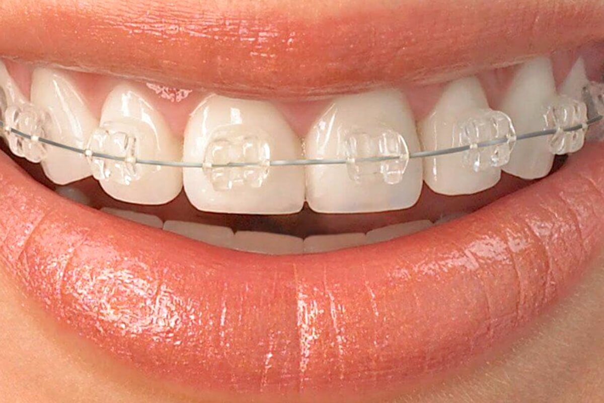 Ceramic Braces  Grant Orthodontics